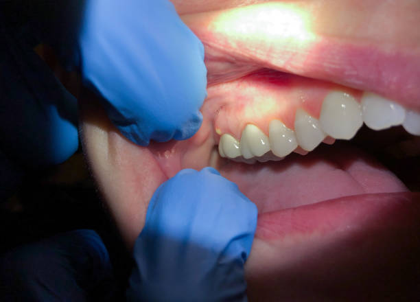 Best Emergency Treatment for Toothache in Wynantskill, NY
